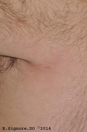 This photo shows the same individual after being treated by Dr. Signore with DOXYCYCLINE, an antibiotic used to treat EARLY LYME DISEASE.  As you can see, the "BULL'S-EYE RASH" of early Lyme Disease (aka Erythema Migrans) is ALL CLEAR.  This case shows the importance of EARLY DIAGNOSIS & TREATMENT of Lyme Disease.  If Lyme Disease is not detected early, it can lead to SERIOUS HEALTH PROBLEMS, such as facial paralysis, heart problems, arthritis, difficulty speaking, and difficulty with concentration and thought processes.