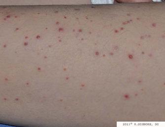 Topical steroid treatment for eczema