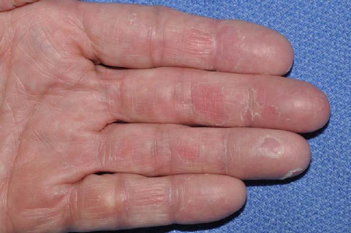 This photo shows a gentleman seen in Dr. Signore's dermatology office in Tinley Park, Illinois with a 12 year history of chronic hand eczema.  It prevented him from playing the guitar.  He has failed numerous prescription steroid creams by his other physicians.  This photo shows his fingers before homeopathic therapy.