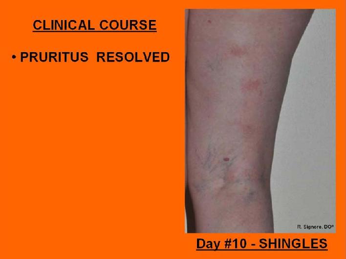Picture of herpes zoster patient experiencing improvement of shingles rash after being treated with homeopathic medicine