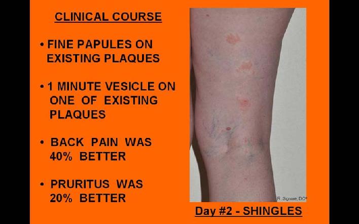 Photo showing same woman with shingles of the right leg.  Within two hours, the lower back shingles pain was partially improved.  By the second day, the shingles resh's itching began to lessen in severity.