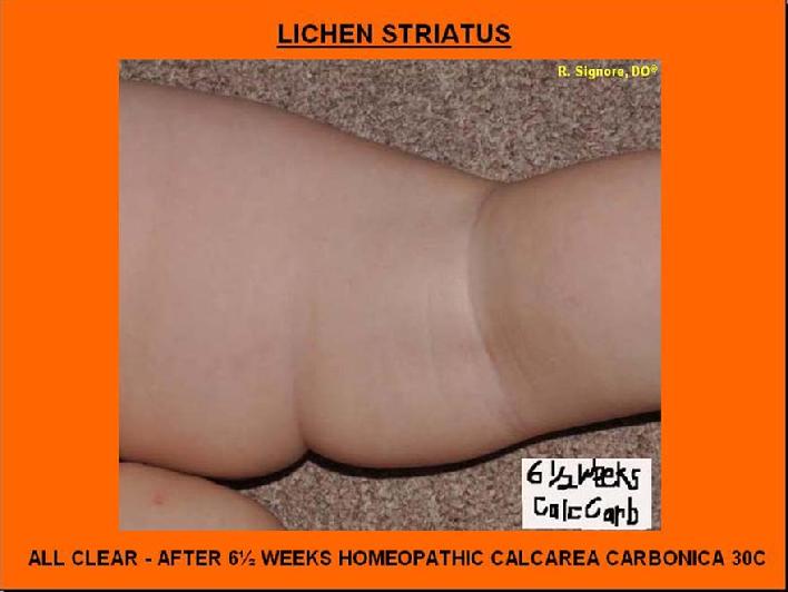 This photo of the same infant with lichen striatus, at six and one-half weeks homeopathic treatment, shows that her eruption has completely resolved.  Note:  the rash of lichen striatus normally takes 3 to 12 months to spontaneously resolve.  