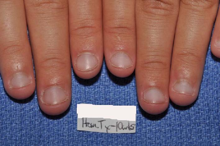 At 10 weeks after beginning homeopathic medicine, this patient's periungual warts are completely resolved.  Note: there was no discomfort or scarring.