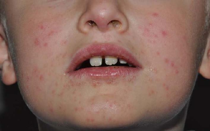 Photograph of young child, seen in Dr. Signore's dermatology office, with perioral dermatitis before treatment.