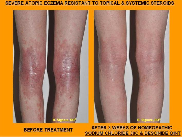 This photo shows a young woman severe eczema on the legs before and after 3 weeks' treatment with homeopathic sodium chloride and topical desonide ointment.  Her eczema severity improved by approximately 70%.  Interestingly, her sadness and anger greatly improved, and she was much happier.