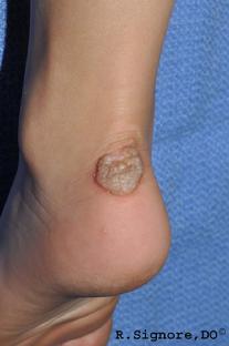 This pleasant youngster, seen above, was brought to Dr. Signore's dermatology office with treatment resistant warts on her foot which began one year ago.  Her previous skin doctors had already tried Aldara cream (imiquimod cream), cantharidin, freezing with liquid nitrogen, and 40% salicylic acid ointment.  The patient and her parents wanted to try a wart treatment that was not painful.  So, Dr. Signore selected a homeopathic natural remedy which was derived from a flower of the Ranunculaceae plant family.  The patient took two dissolvable pellets by mouth twice a day.