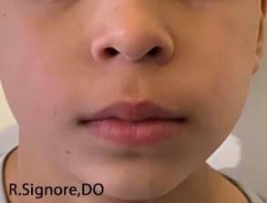 This PHOTO shows the same patient - now he is 7 years old.  Even though he finished his HOMEOPATHIC TREATMENT six years ago, note that his ECZEMA IS STILL ALL CLEAR.