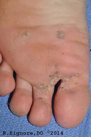 This young patient saw Dr. Signore for resistant PLANTAR WARTS.  They did not respond to her previous doctor's salicylic acid liquid, freezing, or cimetidine (Tagamet).  When her previous doctor surgically removed her warts, she couldn't participate in sports for three months afterwards.  Then, her warts grew back.  She scheduled a two hour homeopathic office visit with Dr. Signore and he prescribed her individualized homeopathic constitutioinal remedy.  She was a very warm individual, her hands and feet sweated excessively (HYPERHIDROSIS), she was very thirsty for large amounts of ice water, and she disliked eggs.  These symptoms helped Dr. Signore find the right homeopathic mineral remedy.