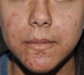 Photo of acne excoriee patient 4 weeks after homeopathic treatment with natrum muriaticum 1M (constitutional treatment) and calcarea phosphorica 30C.  Her excoriations have almost completely healed.  Interestingly, her anxiety and severe menstrual cramps have improved as well.  Her insomnia has completely resolved.  