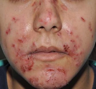 Pre-treatment photo of acne patient with cutaneous excoriations