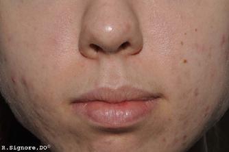 The photo above shows Dr. Signore's same patient AFTER 19 weeks of treatment with her individualized homeopathic medicine which she took by mouth.  As you can see, her ACNE PIMPLES have improved AFTER taking the homeopathic remedy that Dr. Signore prescribed.  He asked her numerous questions to determine what her CONSTITUTIONAL REMEDY was.  (NOTE:  No antibiotics or topical acne lotions or creams were used.) 