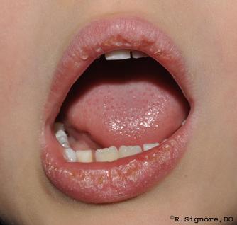 This young child came to Dr. Signore's dermatology office with DRY, FLAKY, &  CRACKED LIPS for as long as his parents could remember (See above photograph).  They had to frequently apply Vaseline and lip balm.  This child also had ATOPIC ECZEMA of his legs and trunk.  His parents brought him in to be treated with HOMEOPATHIC MEDICINE for his eczema.  Dr. Signore asked his parents many questions during his initial two hour homeopathic office visit.  He was given his individualized CONSTITUTIONAL REMEDY based on his physical type, skin symptoms, and emotional / personality traits.  He took his constitutional remedy by mouth once per day.