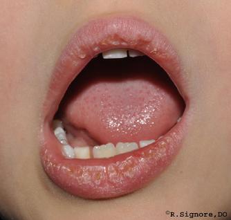 This young child came to Dr. Signore's dermatology office with DRY, FLAKY, & CRACKED LIPS for as long as his parents could remember (See above photograph). They had to frequently apply Vaseline and lip balm. This child also had ATOPIC ECZEMA of his legs and trunk. His parents brought him in to be treated with HOMEOPATHIC MEDICINE for his eczema. Dr. Signore asked his parents many questions during his initial two hour homeopathic office visit. He was given his individualized CONSTITUTIONAL REMEDY based on his physical type, skin symptoms, and emotional / personality traits. He took his constitutional remedy by mouth once per day.