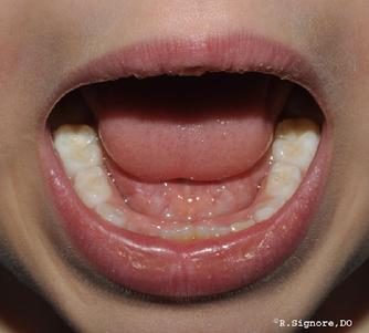 The photo above shows this same young child AFTER 9 WEEKS of taking his HOMEOPATHIC REMEDY. You can see his lips are SMOOTHER & his lips ARE NO LONGER CRACKED. His parents do not have to apply Vaseline or lip balm. (NOTE: NO topical steroids were used.) His ATOPIC ECZEMA on his legs and trunk are about 80% BETTER after 9 weeks of taking his HOMEOPATHIC CONSTITUTIONAL REMEDY. Also, this child's RESTLESS BEHAVIOR IN SCHOOL has IMPROVED since he began homeopathic medicine. Finally, this patient's MOLLUSCUM CONTAGIOSUM cleared up after taking his CONSTITUTIONAL HOMEOPATHIC TREATMENT. It is not uncommon for other seemingly unrelated medical issues to improve during homeopathic treatment.