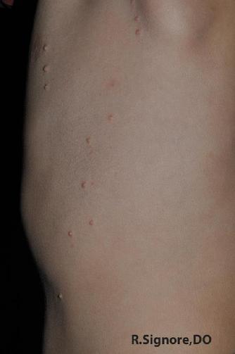 This young boy had a common viral skin infection called MOLLUSCUM CONTAGIOSUM for 7 months.  Dr. Signore asked his parent questions about his skin, but also about his personality, physical, and emotional characteristics.  Based on this personalized evaluation, Dr. Signore prescribed his HOMEOPATHIC CONSTITUTIONAL REMEDY which he took by mouth each day.  Please look to the right of this photo to see his excellent results after three months of homeopathic treatment -->.
