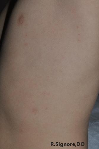 This is the same young boy after three months of HOMEOPATHIC CONSTITUTIONAL MEDICINE.  You can see ALL HIS MOLLUSCUM CONTAGIOSUM ARE COMPLETELY HEALED!  Even his other molluscum lesions located in more sensitive areas of the body have completely cleared up.  Interestingly, he is now calmer and his loose bowels have completely resolved.  As you know, it is not uncommon for seemingly unrelated medical issues to improve with CLASSICAL HOMEOPATHIC MEDICINES.  For information on how to schedule a homeopathic consultation with Dr. Signore, please click on this photo.