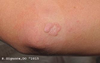 This young patient came to Dr. Signore's dermatology office with a wart the size of a nickel located on her elbow.  It was present for eighteen months.  She had already been to two other dermatology practices and had failed treatment with liquid nitrogen freezing, topical cantharidin, and electrosurgery.   She was afraid to have any further painful wart treatments, so she and her parent wanted to try HOMEOPATHIC MEDICINE.  