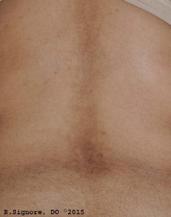 This is the same girl with ACANTHOSIS NIGRICANS after 12 WEEKS of homeopathic treatment. Her ACANTHOSIS NIGRICANS on her back, forehead, neck, arms, and chest has become lighter and smoother. Additionally, since she has begun taking her homeopathic remedy by mouth, her FACIAL ACNE has improved and her SADNESS has also improved. Her FATIGUE has improved and she now has MORE ENERGY which has enabled her to participate more in school gym activities! She is continuing to AVOID PROCESSED SUGARS, CORN SYRUP, & WHITE FLOUR.