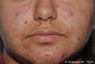 The above photo shows a patient who came to Dr. Signore's Tinley Park dermatology office for treatment of her ACNE PIMPLES.  She had been treated by her previous dermatologist with antibiotics by mouth, but she had become allergic to one and had stomach upset from the other.  So, she was interested in trying natural homeopathic medicines for her acne.