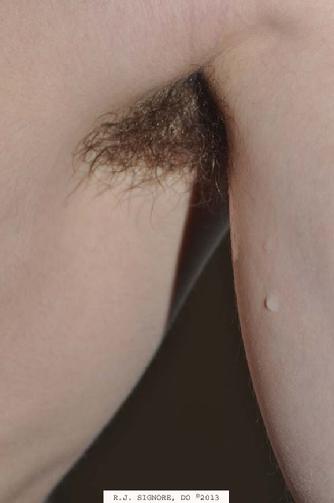 This this photo shows a patient who sought treatment in Dr. Signore's Tinley Park dermatology office for excessive sweating (hyperhidrosis) of the underarms and hands for the past 4 years. He had tried antiperspirants without success. His severe hyperhidrosis caused sweat to drip from the underarms for most of the day. This patient underwent a two hour initial homeopathic office interview during which time Dr. Signore asked numerous questions pertaining to both the perspiration problem and many other aspects of his health. This allowed Dr. Signore to select his individualized homeopathic medicine which best matched the patient's skin problems.