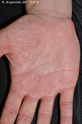 This young man has suffered with EXCESSIVE SWEATING (HYPERHIDROSIS) of the hands and feet since early grade school.  For him, hyperhidrosis was not only embarrassing, but it interfered with his business.  It was hard to work with paper (because sweat from the hands made paper receipts and forms wet).  His sweating also made working with his hands difficult because of the excessive sweat.  He had tried iontophoresis without benefit.  He had read about HOMEOPATHIC MEDICINE as a treatment for HYPERHIDROSIS and he sought treatment with Dr. Signore's dermatology office in Tinley Park, Illinois.  He filled out the pre-homeopathic evaluation questionnaire and then had a two-hour initial homeopathic evaluation with Dr. Signore.  During the interview, Dr. Signore asked a lot of questions to better determine this patient's unique physical, emotional, and intellectual characteristcs.  This helped him find the patient's correct CONSTITUTIONAL HOMEOPATHIC REMEDY.  The photo above shows the patient's profuses sweating BEFORE treatment.