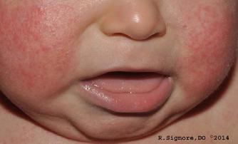 This 6 month old infant was diagnosed by Dr. Signore with ATOPIC ECZEMA (atopic dermatitis).  Atopic eczema is an itchy skin disease which is commonly seen in infants and children.  Atopic eczema is seen in about 3 percent of young children.  Atopic eczema often begins around three months old, but it can occur sooner.  There is NO CURE for eczema, but dermatologists have helpful treatments than can keep eczema under control.  As children with ATOPIC ECZEMA get older, they often develop ASTHMA or ALLERGIC RHINITIS (Hayfever, Seasonal Allergies).  Children with atopic eczema often have other family members with eczema, asthma, or allergies.