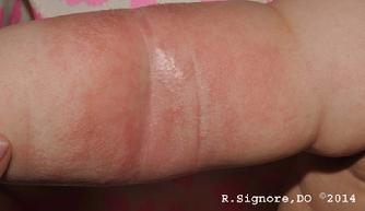 This 6 month old infant was diagnosed by Dr. Signore with ATOPIC ECZEMA (atopic dermatitis). Atopic eczema is an itchy skin disease which is commonly seen in infants and children. Atopic eczema is seen in about 3 percent of young children. Atopic eczema often begins around three months old, but it can occur sooner. There is NO CURE for eczema, but dermatologists have helpful treatments than can keep eczema under control. As children with ATOPIC ECZEMA get older, they often develop ASTHMA or ALLERGIC RHINITIS (Hayfever, Seasonal Allergies). Children with atopic eczema often have other family members with eczema, asthma, or allergies.