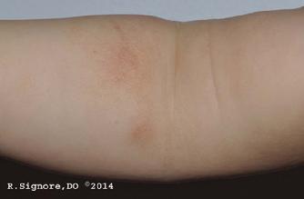 This is the same infant, as seen in the above photo. Notice his right arm eczema is MUCH IMPROVED with Dr. Signore's constitutional homeopathic remedy which was begun 5 1/2 weeks ago. The eczema on the face, neck, and legs also improved considerably.