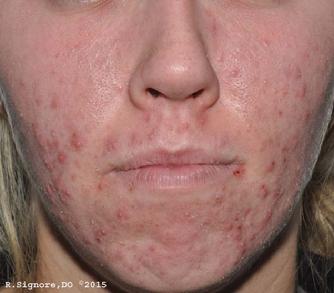 photo of a person with acne vulgaris (acne pimples)
