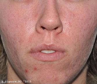 This photo shows the same patient TEN WEEKS after beginning treatment by Dr. Signore with natural CLASSICAL HOMEOPATHIC MEDICINE.  She had already tried conventional acne treatments (topical creams and oral antibiotics) but she now wanted to try a natural approach.  After filling out a questionnaire, she scheduled a 2 hour initial homeopathic office visit, where Dr. Signore asked many questions about her acne, but also about her personality, diet, sleep, exercise, and many other details of her life.  Based upon this, Dr. Signore  prescribed her individualized CONSTITUTIONAL HOMEOPATHIC REMEDY which she took by mouth each day (which in her case happened to be a common homeopathic mineral remedy).  As you can see, her complexion has improved and she is getting fewer new pimples.  In addition to her homeopathic medicine, which she took by mouth, she also applied GLYCOLIC ACID CREAM and ADAPALENE GEL 0.1% every day for her acne.  NOTE: NO ANTIBIOTICS WERE USED.