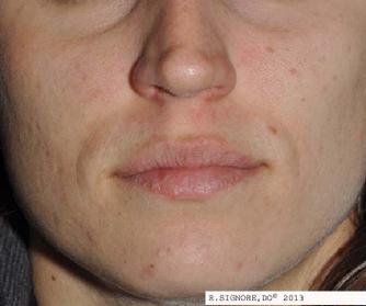 Photo of same patient.  At 21 weeks, her facial acne is much improved with homeopathic sodium chloride by mouth and Aquaglycolic Face Cream topically.
