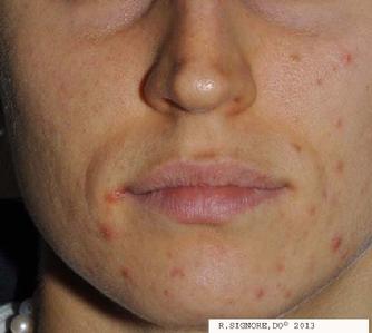 This young lady was evaluated at Dr. Signore's Tinley Park, Illinois dermatology office for facial acne pimples.