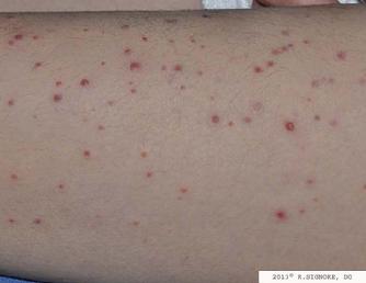 This photo shows a patient seen in Dr. Signore's Tinley Park, Illinois dermatology office with MOLLUSCUM CONTAGIOSUM before homeopathic medical treatment.