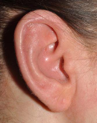 This photo shows Dr. Signore's patient after treatment with a gluten-free diet. Her ears and elbows are completely healed.