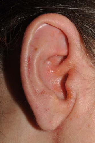 The above two photos show a young woman with an eczema-like rash on the external ears which failed treatment with a prescription topical steroid, Protopic ointment, and econazole cream. She also failed three homeopathic remedies.