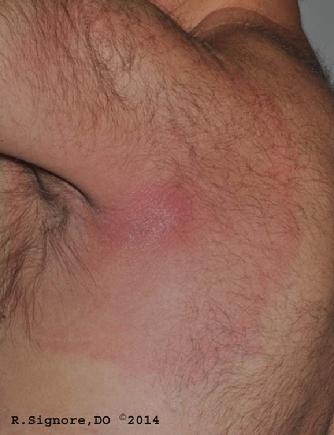 This photo shows a patient who was just diagnosed by Dr. Signore with EARLY LOCALIZED LYME DISEASE.  This eruption, known as ERYTHEMA MIGRANS, is the EARLIEST SKIN SIGN of Lyme Disease.  This case demonstrates the importance of seeing your dermatologist for evaluation of an unexplained rashes of sudden onset.  Lyme Disease is a SERIOUS BACTERIAL INFECTION spread by ticks.  People can catch Lyme Disease after being bitten by a tick while walking in the woods or tall grass where wildlife, such as deer and mice, are present.  This individual was working outdoors in his garden.  While most Chicagoans associate Lyme Disease with places such as Wisconsin, New York, & Connecticut, this case shows that Lyme Disease is also a threat right here in the SUBURBAN CHICAGO AREA.  
