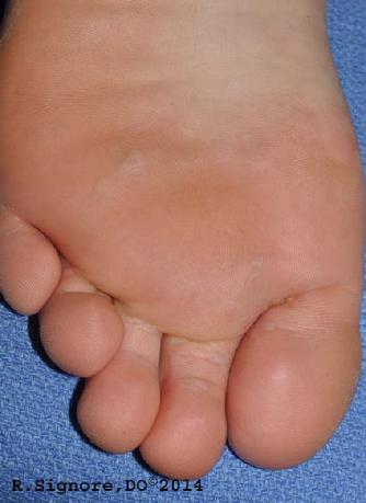 The above photo, taken weeks after beginning the patient's individually selected homeopathic constitutional remedy, shows that all her PLANTAR WARTS have resolved.  Interestingly, her excessive sweating (hyperhidrosis) on her hands has also improved by 50% after beginning her homeopathic medicine.  (See Photos Below)