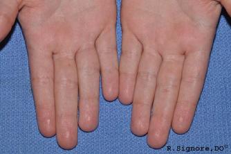 This photo shows EXCESSIVE SWEATING (HYPERHIDROSIS) of the hands of the same young patient seen in the photos above with the plantar warts.  This photo is before homeopathic treatment.