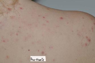 Young woman with acne pimples on right shoulder prior to homeopathic treatment