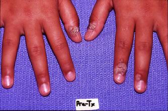 This patient of Dr. Signore had numerous warts around the nails, which can be particularly difficult to treat. (R. Signore, DO - Copyright.)