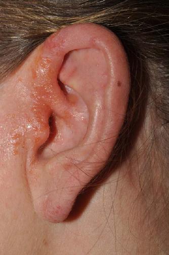 This is a photo of a young woman seen in Dr. Signore's dermatology office with a stubborn eczema-like rash for 4 years.  Several physicians treated her previously with a topical steroid ointment, Protopic ointment, and econazole cream without success.  This photo shows the severe eruption on the left ear prior to treatment. 