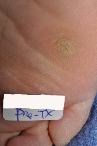 This is a pre-treatment photo of a patient with a painful plantar wart which was successfully treated in Dr. Signore's dermatology office in Tinley Park, Illinois.  