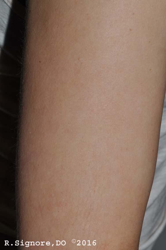 This is the same young woman, SHOWN IN THE PHOTO ABOVE after 20 weeks of CONSTITUTONAL HOMEOPATHIC MEDICINES, prescribed for her individual and characteristic symptoms.   As you can see, her ATOPIC ECZEMA is 98% CLEAR.  Her SKIN IS NOW MUCH SMOOTHER AND SOFTER.  She will now be able to wear her wedding dress, as her shoulders, arms, & upper chest have healed nicely.    Homeopathic medicines are manufactured from natural substances, such as minerals and plants.  Homeopathic medicines are regulated as drugs by the U.S. Food and Drug Administration.  They are manufactured using Good Manufacturing Practices according to the Homeopathic Pharmacopoeia of the United States.  