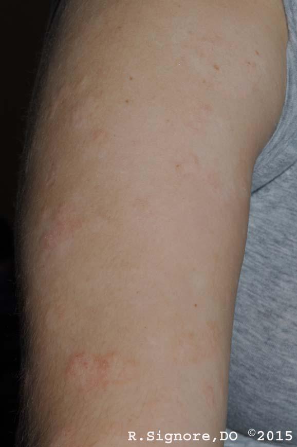 A young woman with WIDESPREAD ATOPIC ECZEMA scheduled a homeopathic consultation with Dr. Signore.  She had suffered with ATOPIC ECZEMA since childhood.  She was getting married in six months, and she needed treatment for her very itchy skin condition.  