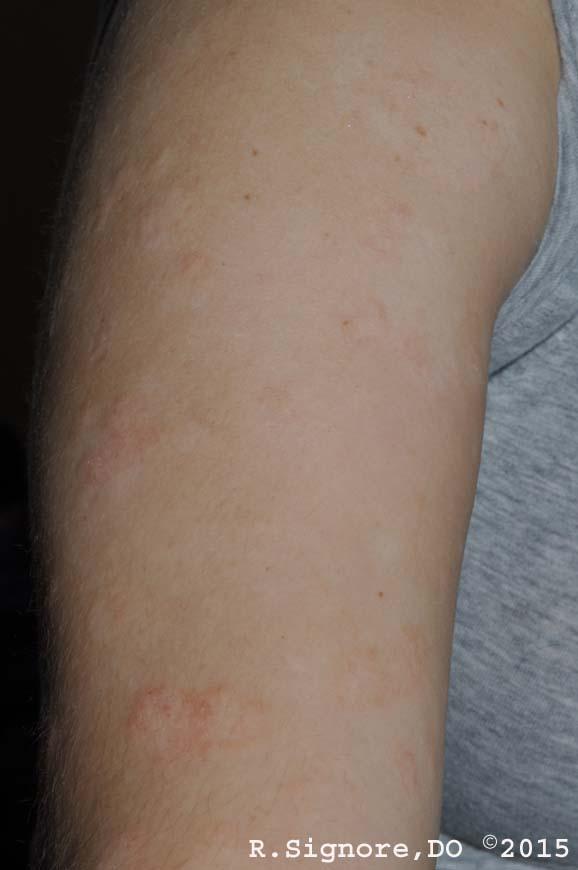 A young woman with WIDESPREAD ATOPIC ECZEMA scheduled a homeopathic consultation with Dr. Signore. She had suffered with ATOPIC ECZEMA since childhood. She was getting married in six months, and she needed treatment for her very itchy skin condition.