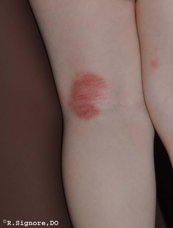 This is a young infant who was brought to Dr. Signore's dermatology office with ATOPIC ECZEMA (see above photo). His pediatrician had treated him with triamcinolone, a prescription steroid cream.