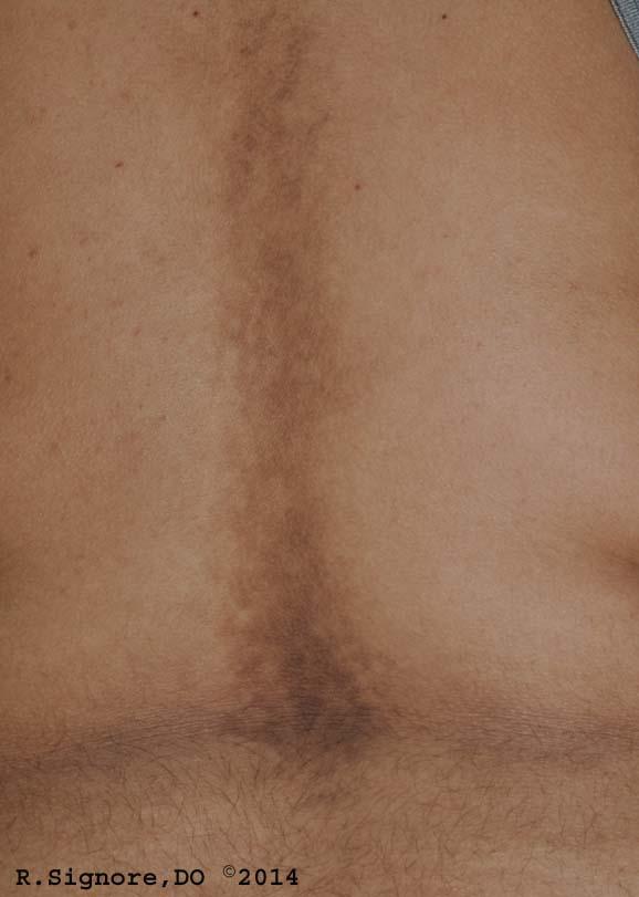 This very nice young girl presented to Dr. Signore's dermatology office because her mother noticed DISCOLORATION of her skin. The photo above shows brownish velvety skin over her LOWER BACK. She also had similar dark patches over her forehead, underarms, chest, and arms. Dr. Signore quickly diagnosed ACANTHOSIS NIGRICANS, a skin condition which can indicate which children are at higher risk for developing TYPE II DIABETES. He prescribed a glycolic acid lotion. Importantly, he spent the next half hour counseling the patient and her family on the importance of AVOIDING PROCESSED SUGAR, WHITE FLOUR, & WHITE RICE, and other high glycemic foods to hopefully REDUCE this patient's RISK of developing DIABETES.