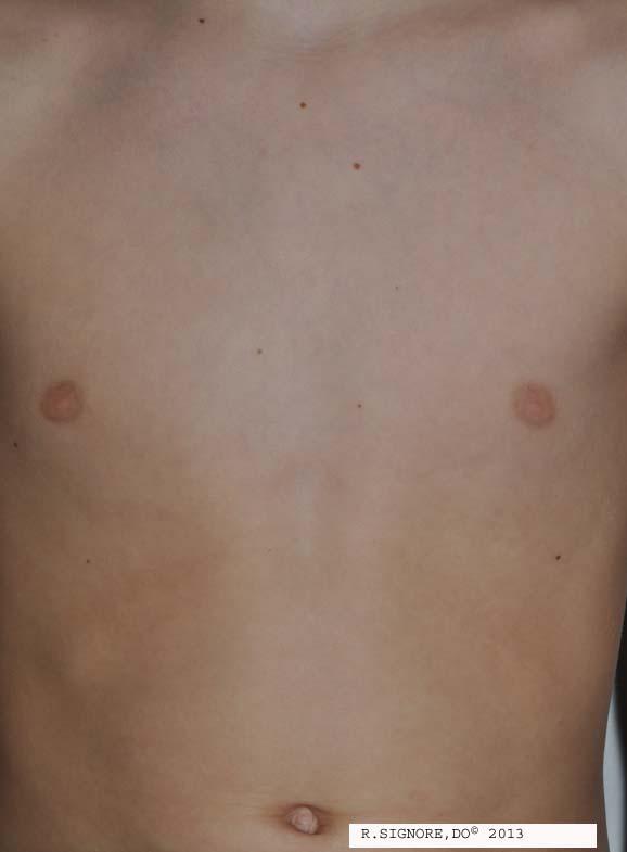 This same child is shown 3 days after being treated by Dr. Signore with the patient's individualized homeopathic medicine.  His acute urticaria (hives) are all clear.  