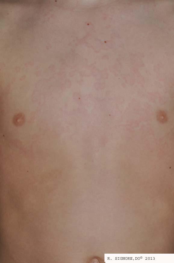 This young boy presented to Dr. Signore's Tinley Park, Illinois dermatology office with a very itchy rash on the arms, chest, and thighs (acute urticaria).   