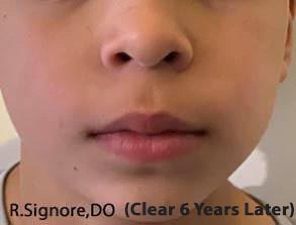 This PHOTO shows this same patient SIX YEARS AFTER FINISHING HIS HOMEOPATHIC MEDICINE.  He is now a healthy seven year old boy & HIS ECZEMA HAS STAYED ALL CLEAR FOR THE PAST SIX YEARS!  This demonstrates that CHILDREN WHO ARE TREATED EARLY IN LIFE WITH HOMEOPATHIC MEDICINE CAN HAVE LONG-LASTING IMPROVEMENT IN THEIR ATOPIC ECZEMA!
